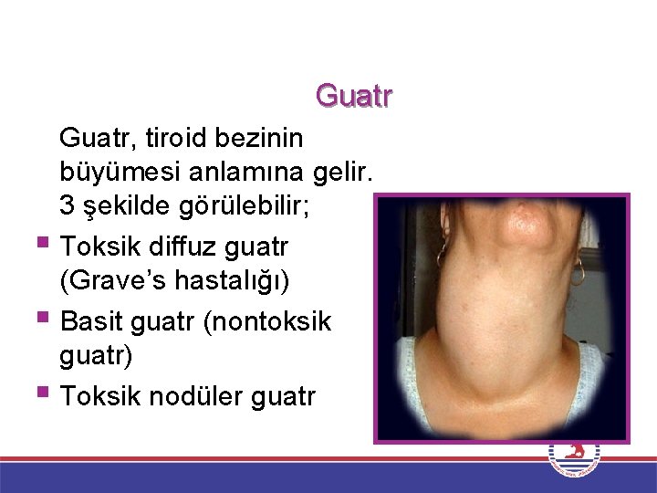 Guatr, tiroid bezinin büyümesi anlamına gelir. 3 şekilde görülebilir; § Toksik diffuz guatr (Grave’s