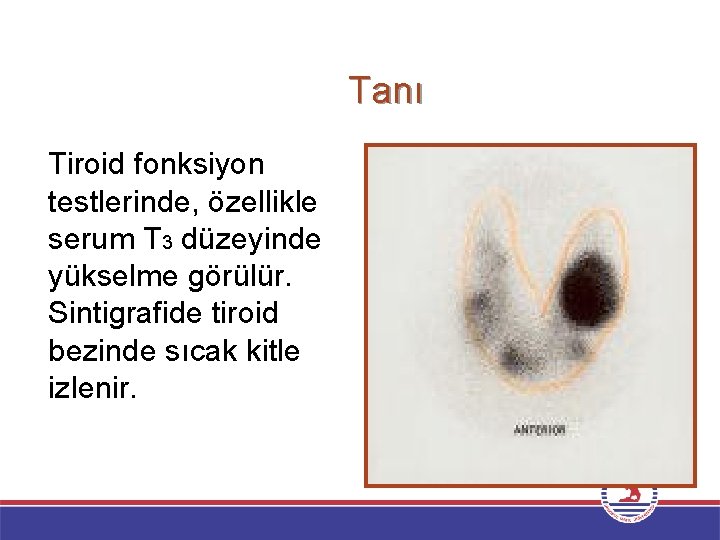 Tanı Tiroid fonksiyon testlerinde, özellikle serum T 3 düzeyinde yükselme görülür. Sintigrafide tiroid bezinde