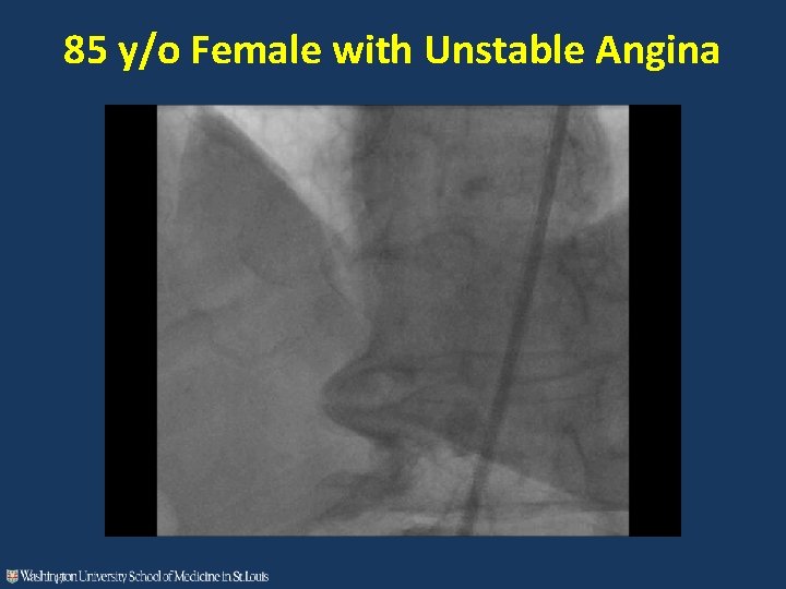 85 y/o Female with Unstable Angina 