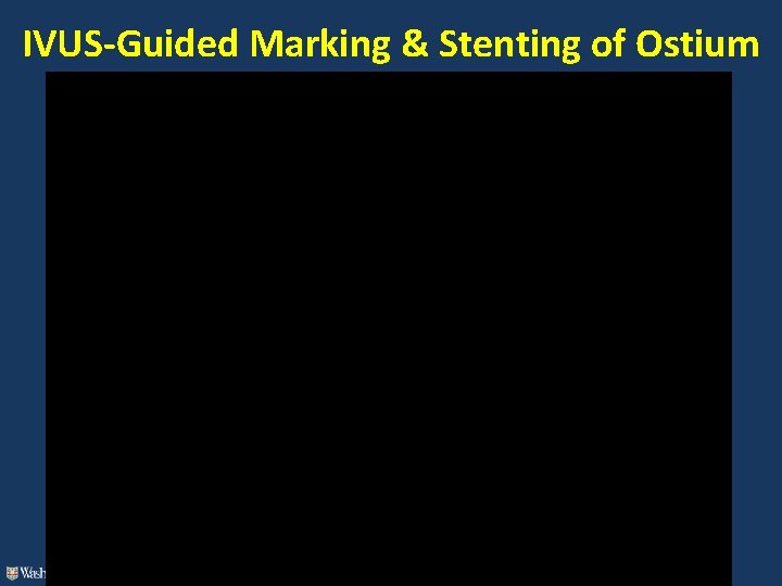IVUS-Guided Marking & Stenting of Ostium 