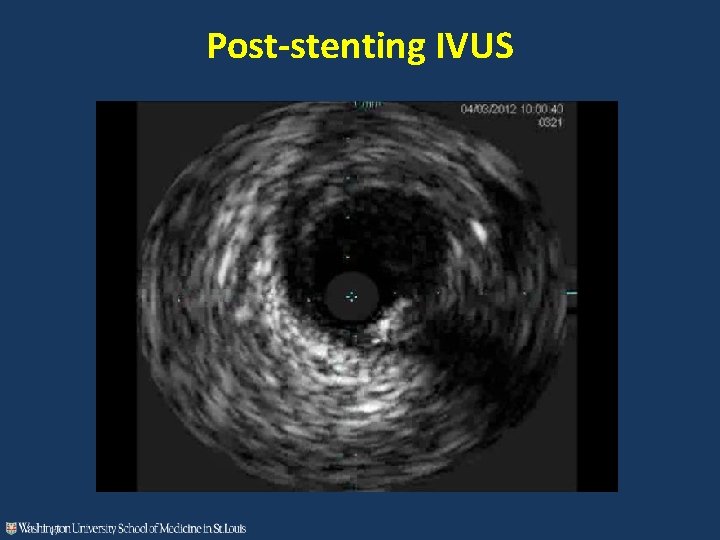 Post-stenting IVUS 