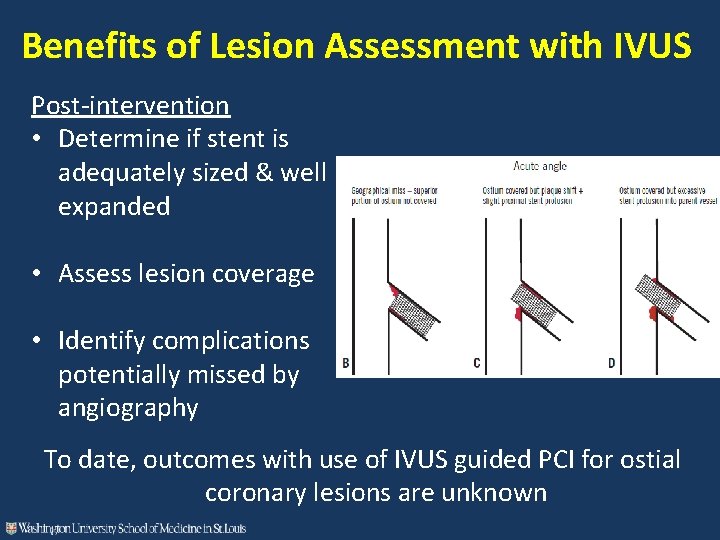 Benefits of Lesion Assessment with IVUS Post-intervention • Determine if stent is adequately sized