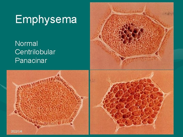 Emphysema Normal Centrilobular Panacinar 2022/1/4 