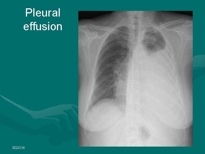 Pleural effusion 2022/1/4 