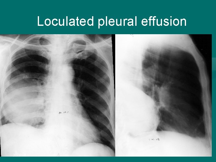 Loculated pleural effusion 2022/1/4 