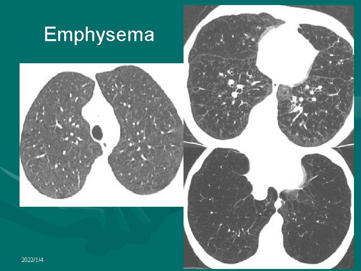 Emphysema 2022/1/4 