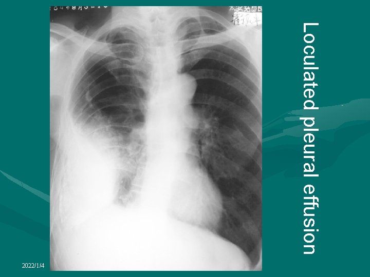 Loculated pleural effusion 2022/1/4 