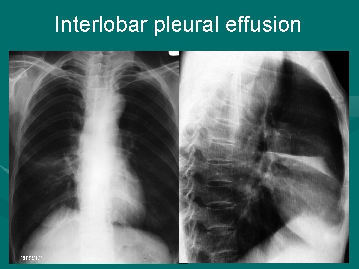 Interlobar pleural effusion 2022/1/4 