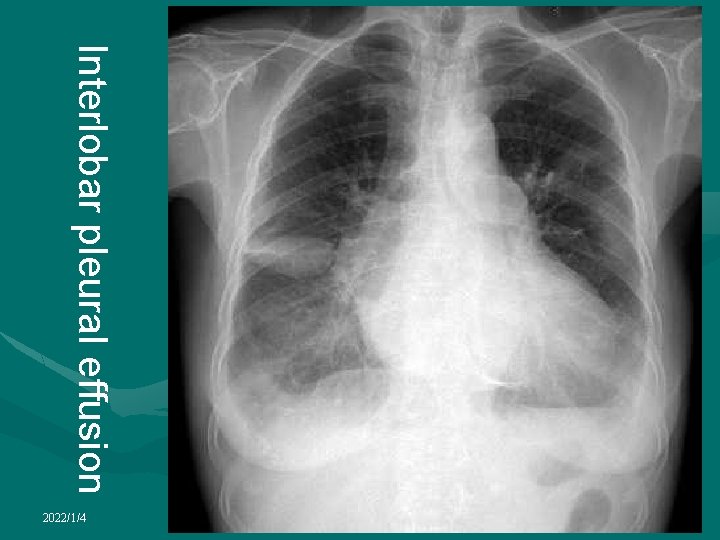 Interlobar pleural effusion 2022/1/4 