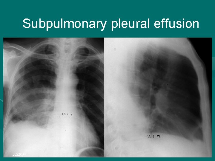Subpulmonary pleural effusion 2022/1/4 