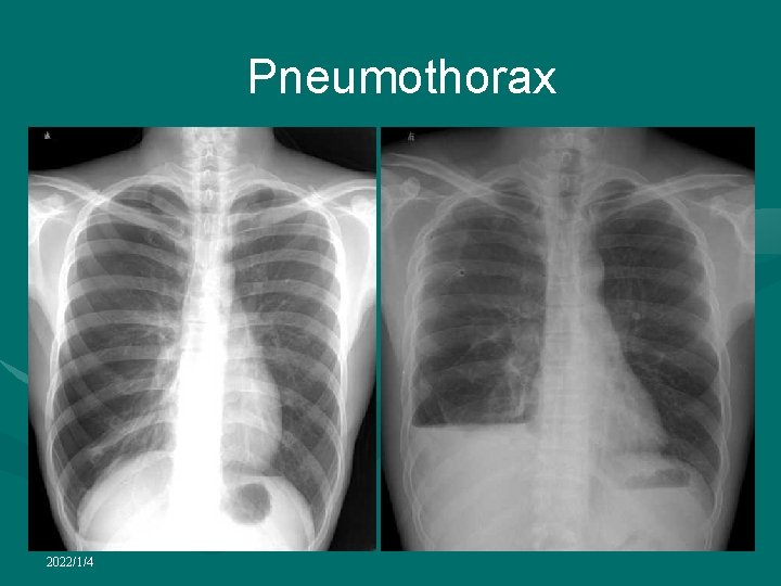 Pneumothorax 2022/1/4 