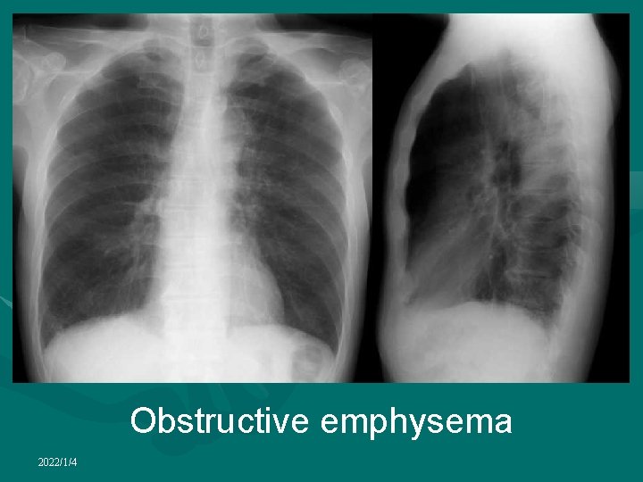 Obstructive emphysema 2022/1/4 