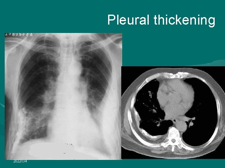 Pleural thickening 2022/1/4 