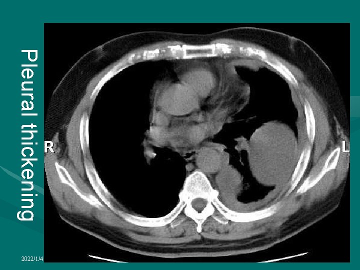 Pleural thickening 2022/1/4 