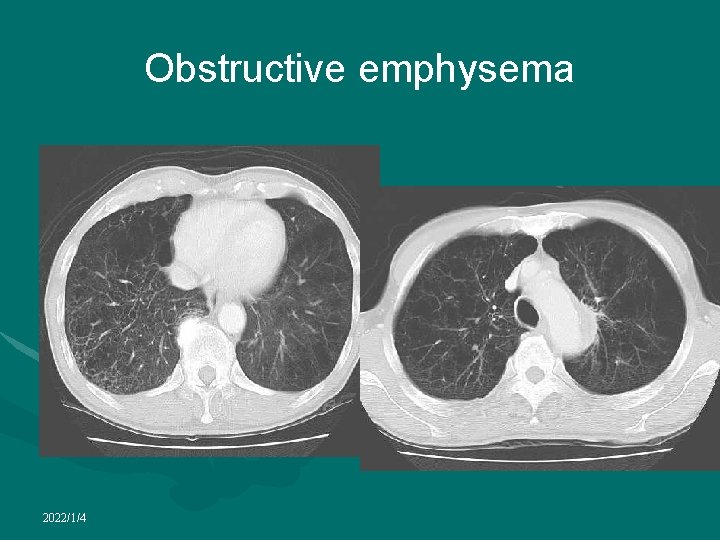 Obstructive emphysema 2022/1/4 
