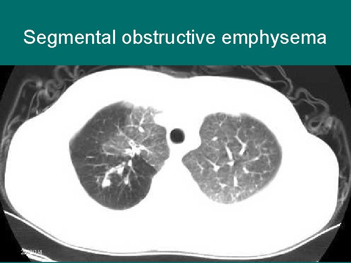 Segmental obstructive emphysema 2022/1/4 