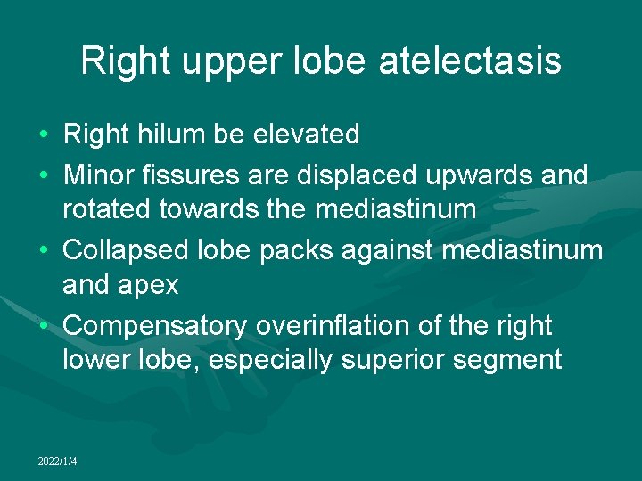 Right upper lobe atelectasis • Right hilum be elevated • Minor fissures are displaced