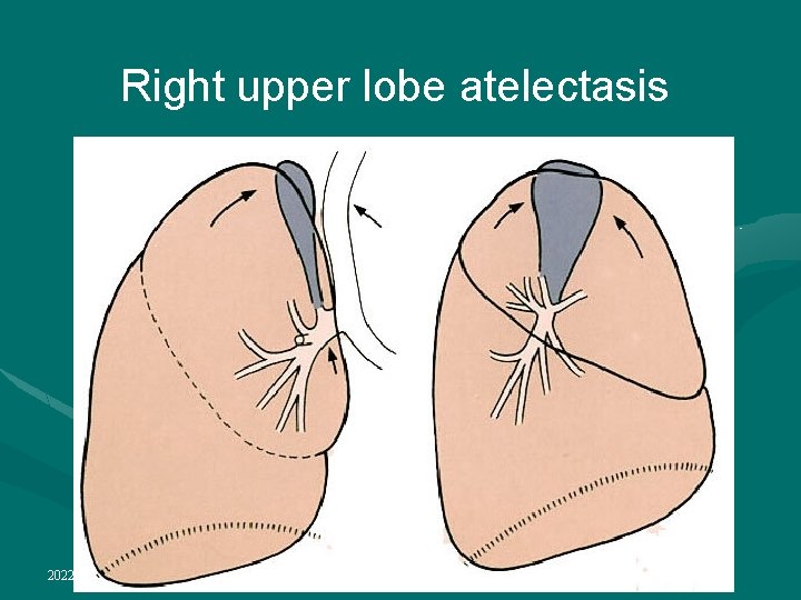 Right upper lobe atelectasis 2022/1/4 