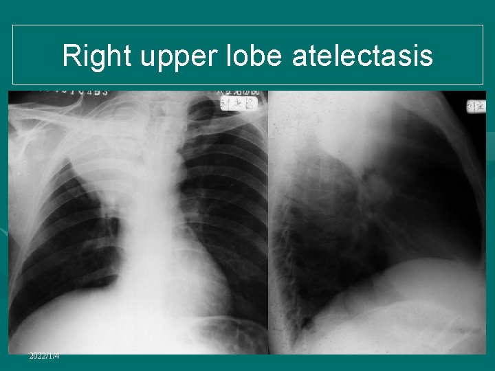 Right upper lobe atelectasis 2022/1/4 