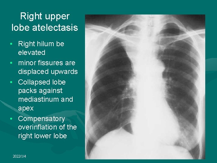 Right upper lobe atelectasis • Right hilum be elevated • minor fissures are displaced