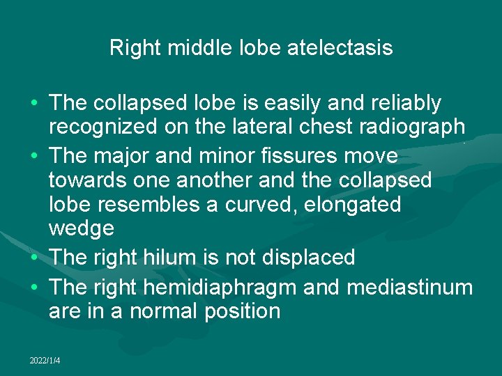 Right middle lobe atelectasis • The collapsed lobe is easily and reliably recognized on