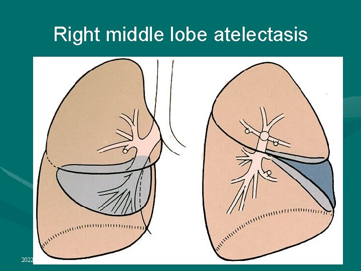 Right middle lobe atelectasis 2022/1/4 