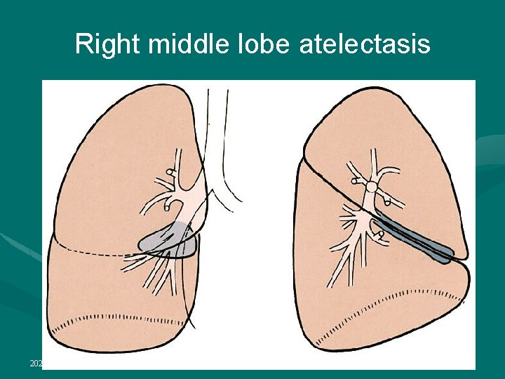 Right middle lobe atelectasis 2022/1/4 