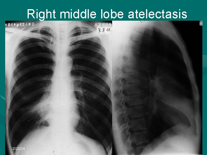 Right middle lobe atelectasis 2022/1/4 