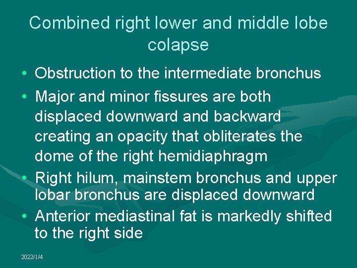 Combined right lower and middle lobe colapse • Obstruction to the intermediate bronchus •