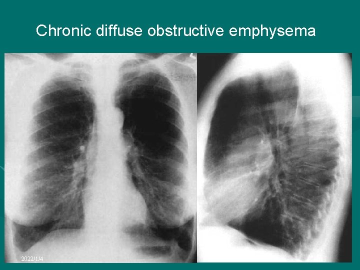 Chronic diffuse obstructive emphysema 2022/1/4 