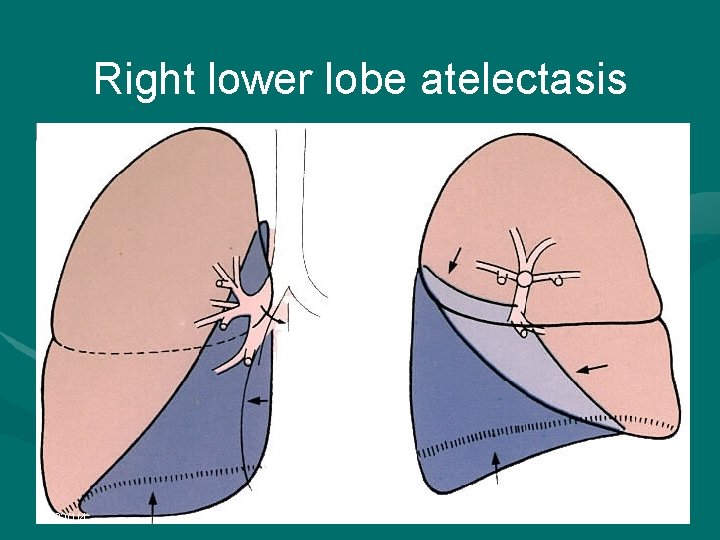 Right lower lobe atelectasis 2022/1/4 