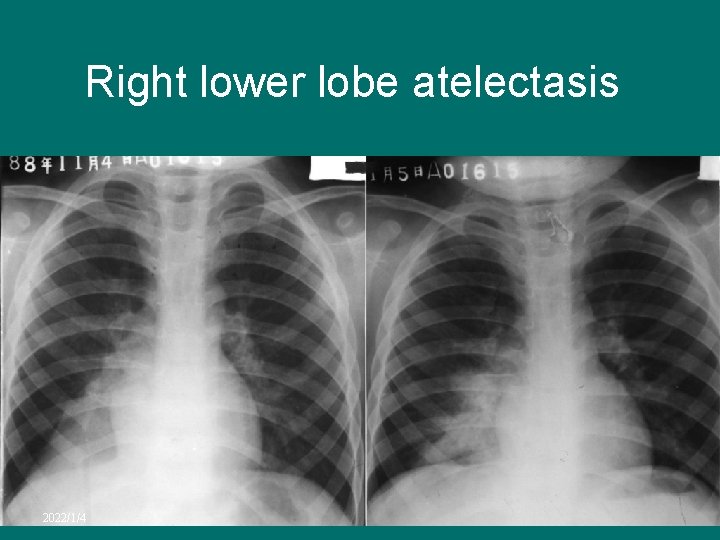 Right lower lobe atelectasis 2022/1/4 