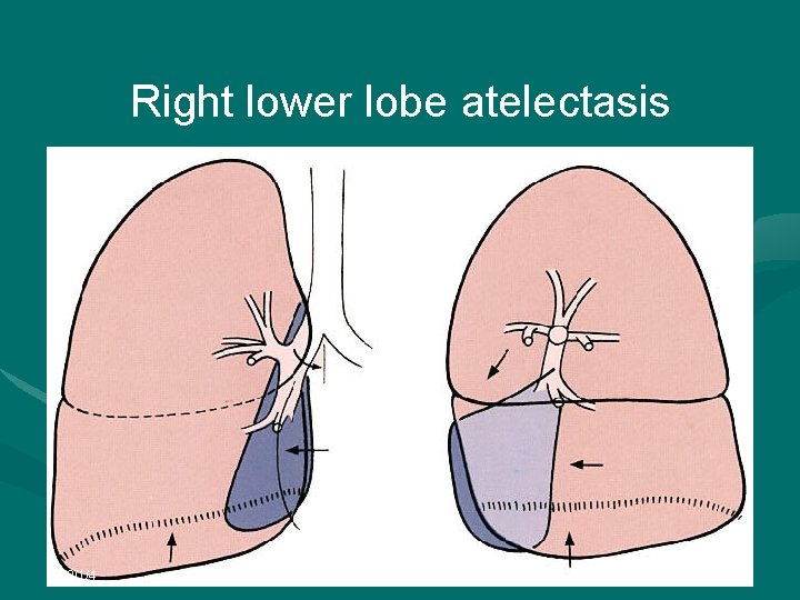 Right lower lobe atelectasis 2022/1/4 
