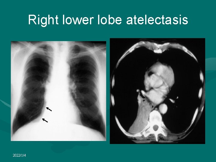 Right lower lobe atelectasis 2022/1/4 