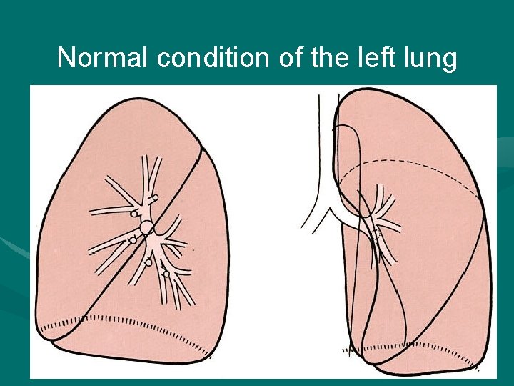 Normal condition of the left lung 2022/1/4 