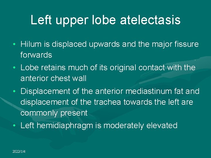 Left upper lobe atelectasis • Hilum is displaced upwards and the major fissure forwards