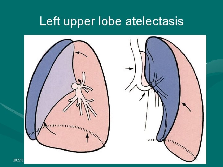 Left upper lobe atelectasis 2022/1/4 