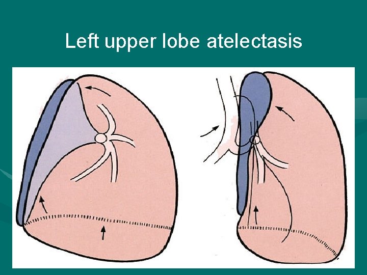 Left upper lobe atelectasis 2022/1/4 