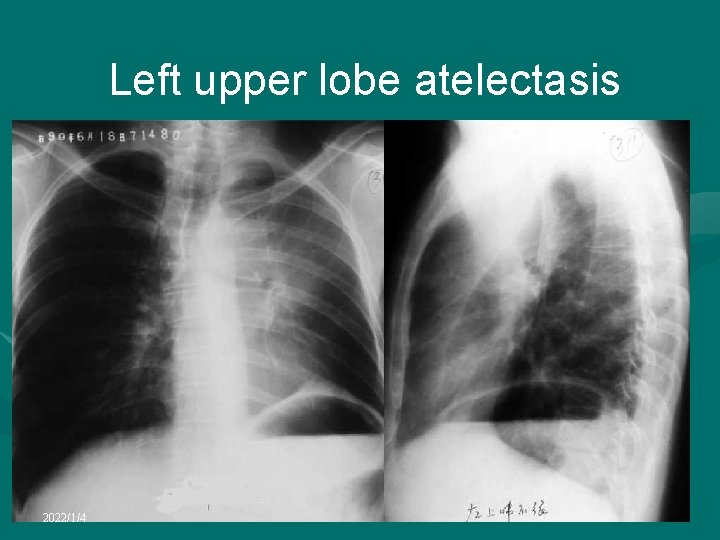 Left upper lobe atelectasis 2022/1/4 