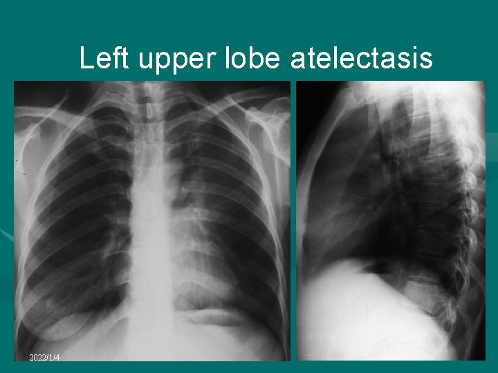 Left upper lobe atelectasis 2022/1/4 