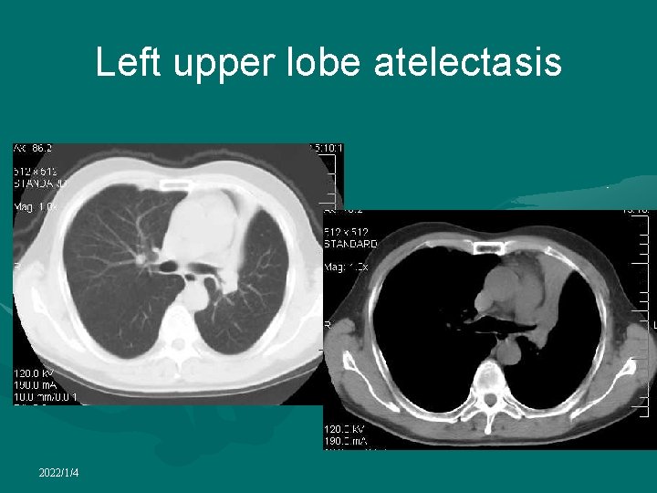 Left upper lobe atelectasis 2022/1/4 