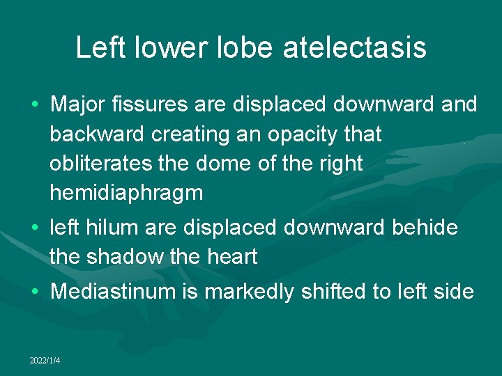 Left lower lobe atelectasis • Major fissures are displaced downward and backward creating an