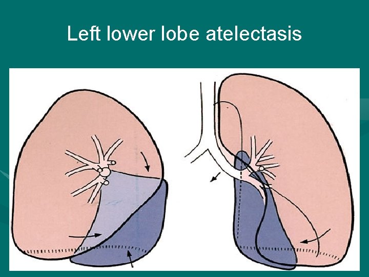 Left lower lobe atelectasis 2022/1/4 