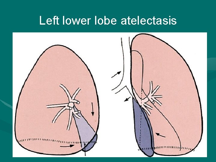 Left lower lobe atelectasis 2022/1/4 