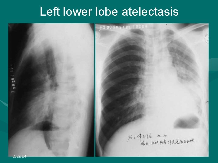 Left lower lobe atelectasis 2022/1/4 