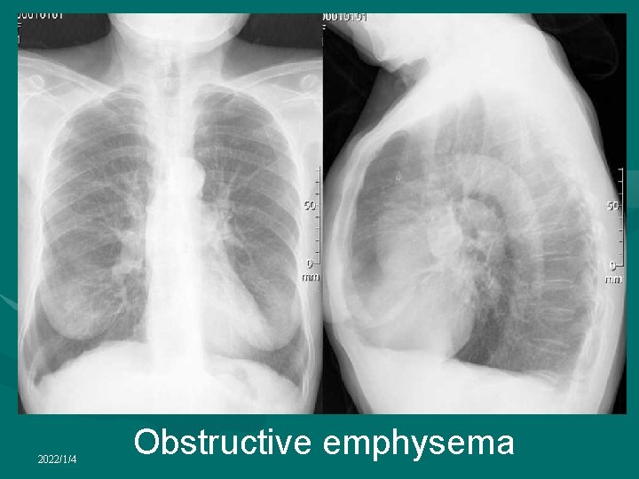 2022/1/4 Obstructive emphysema 