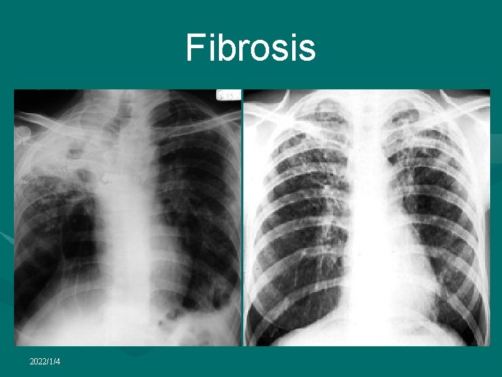 Fibrosis 2022/1/4 