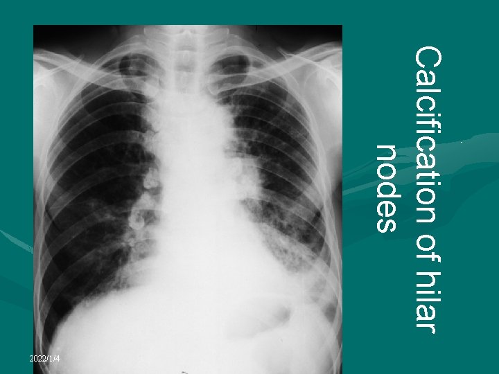 Calcification of hilar nodes 2022/1/4 