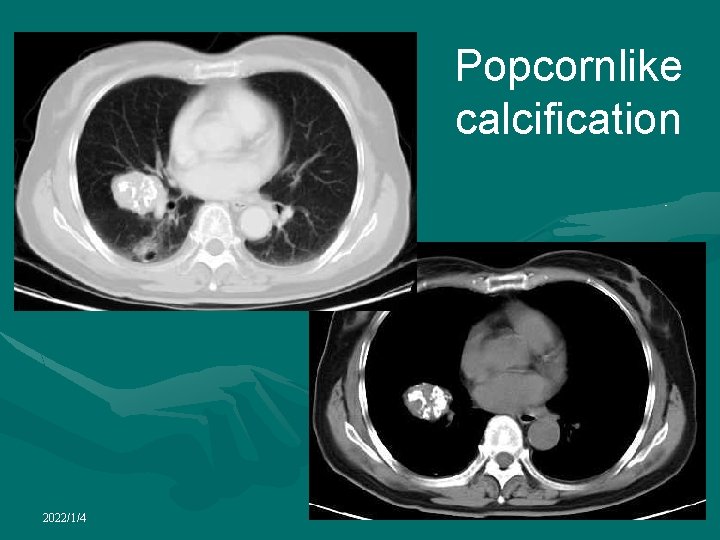 Popcornlike calcification 2022/1/4 