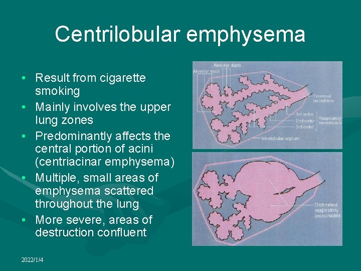 Centrilobular emphysema • Result from cigarette smoking • Mainly involves the upper lung zones